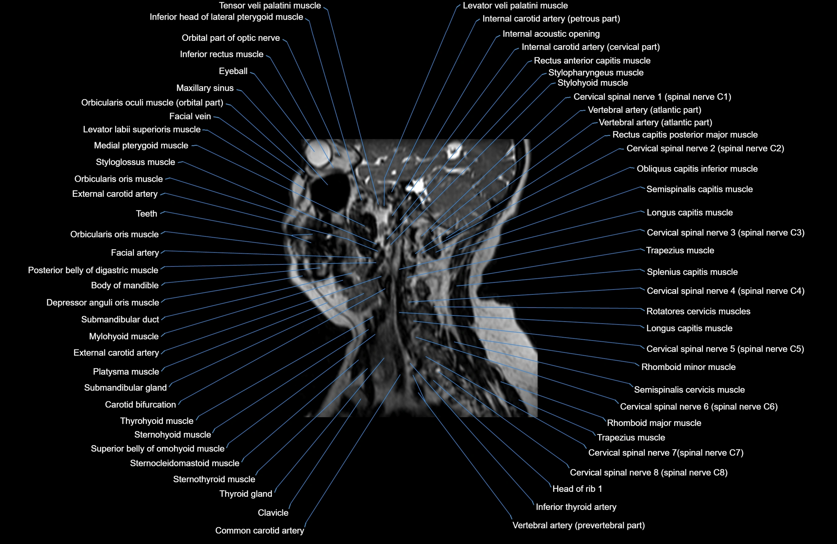 Neck MRI sagittal cross sectional anatomy 3D 1mm 3T radiology  image-img-00001-00017.webp